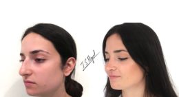 rinoplastia ultrasonica antes y despues rinoplastia ultrasonica antes y despues