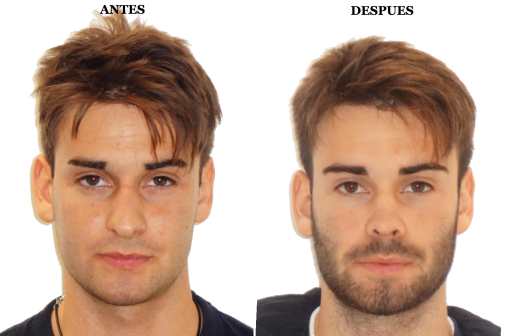 antes y despues rinoplastia