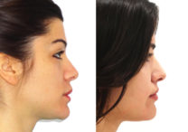 resultado rinoplastia resultado rinoplastia