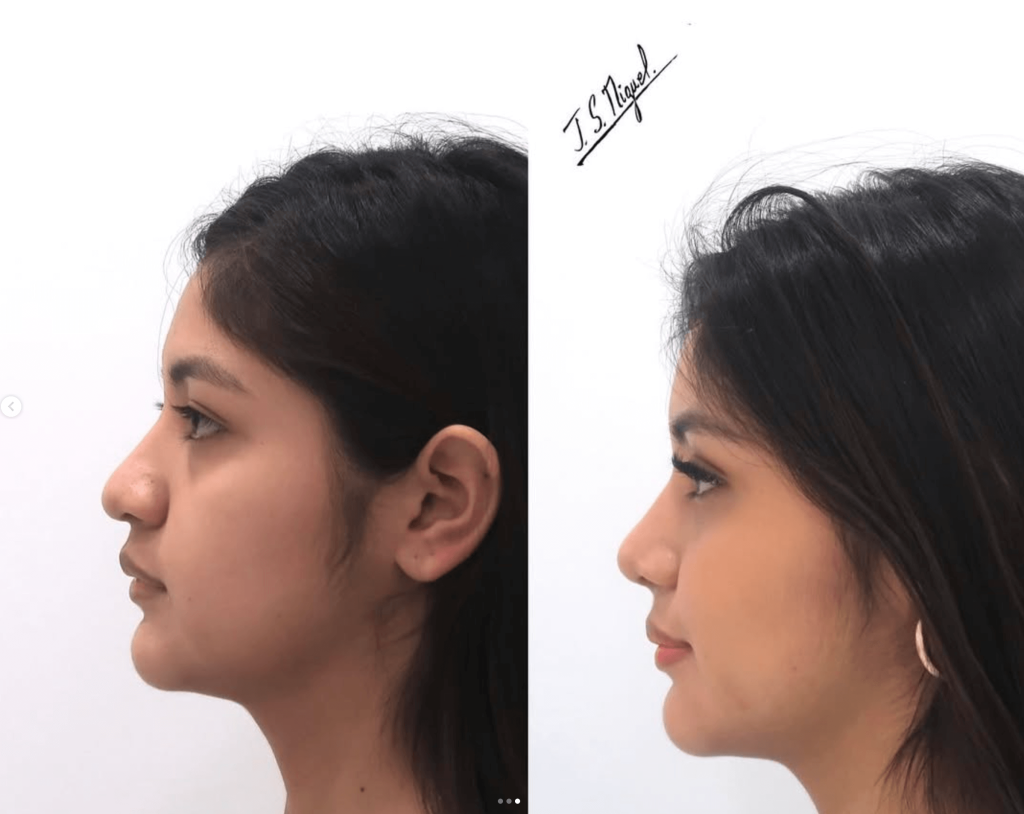 Rinoseptoplastia ultrasónica y resección de bases alares. antes y despues