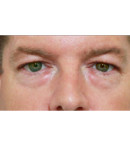 blefaropastia_antes blefaroplastia_antes