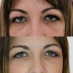 blefaroplastia antes y despues blefaroplastia antes y despues
