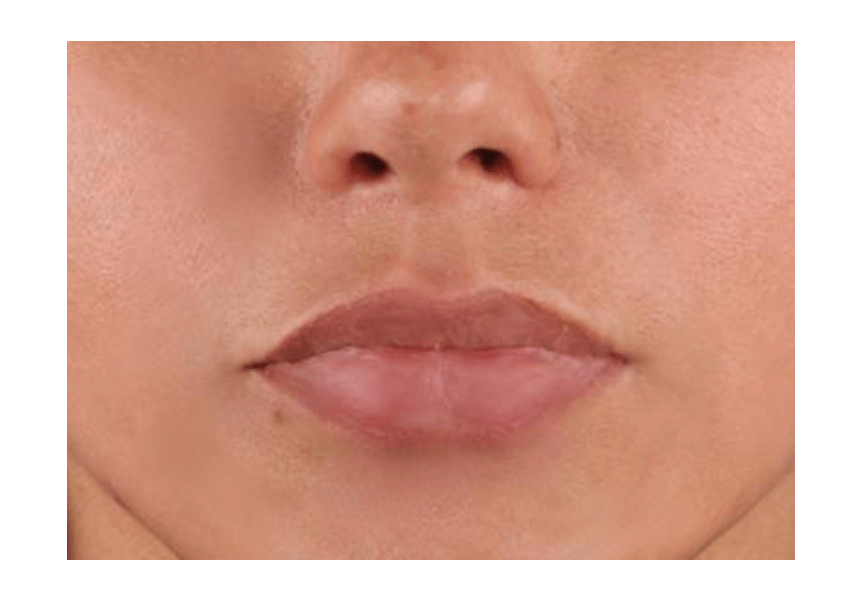 lip_lift_after