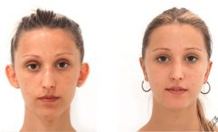 otoplastia-barcelona-dr-san-miguel-2 otoplastia barcelona