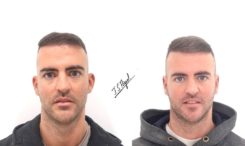 resultados otoplastia hombre resultados otoplastia hombre