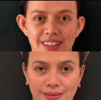 otoplastia mujer. antes y despues otoplastia mujer. antes y despues