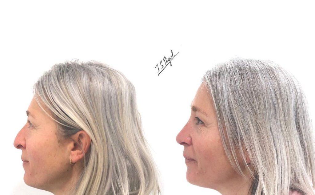 paciente rinoplastia con injerto antes y despues