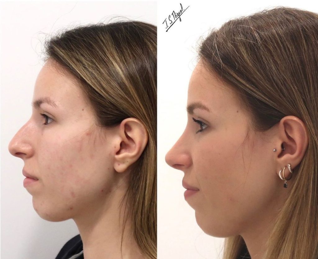 paciente rinoseptoplastia antes y despues