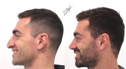 paciente rinoseptoplastia ultrasonioca antes y despues paciente rinoseptoplastia ultrasonioca antes y despues