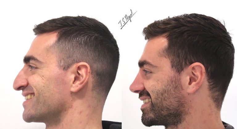 Nariz aguileña. Qué es y cómo corregirla con una rinoplastia - Dr. Joan ...