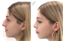 paciente rinoplastia ultrasonica antes y despues paciente rinoplastia ultrasonica antes y despues