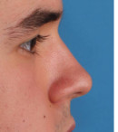 rinoplastia-reduccion-despues rinoplastia-reduccion-despues