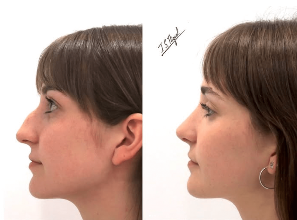 rinoplastia ultrasonica preservacion ligamentos. antes y despues