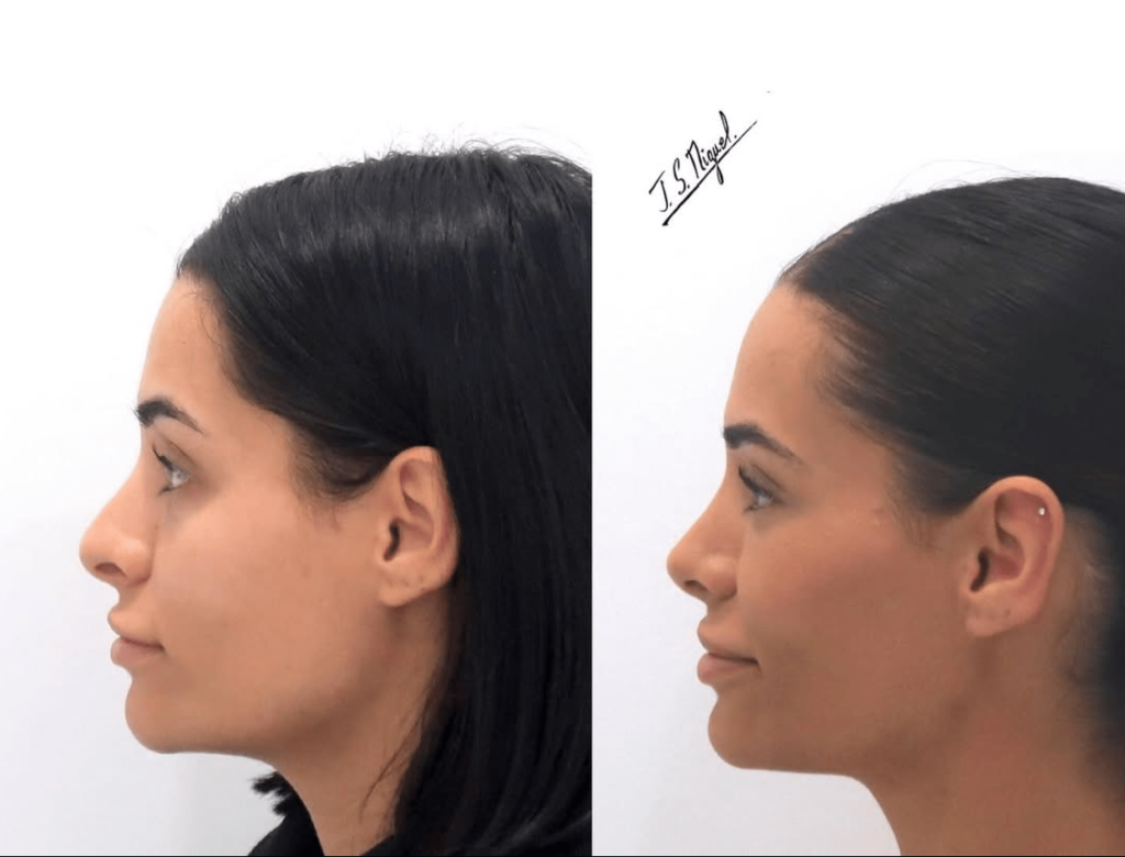 rinoplastia ultrasonica. antes y despues