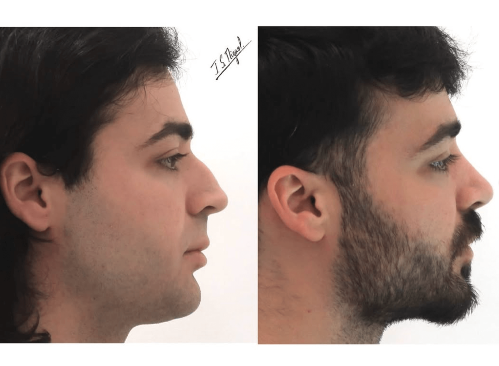 rinoseptoplastia ultrasonica. antes y despues